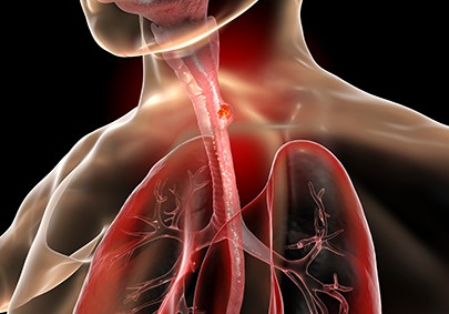 Esophageal Adenocarcinoma