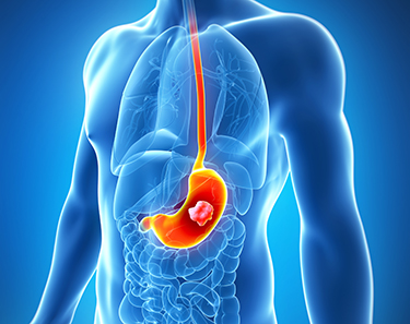 Gastric Cancer