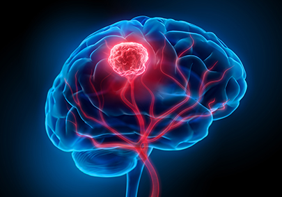 Glioblastoma Multiforme