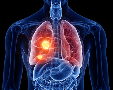 Non-Small Cell Lung Cancer