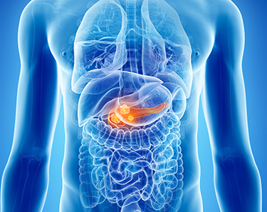 Pancreatic Cancer